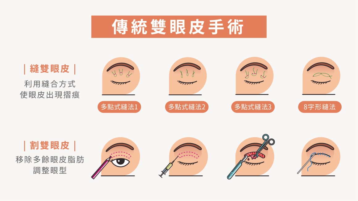 誠美學診所縫雙眼皮及割雙眼皮手術簡介