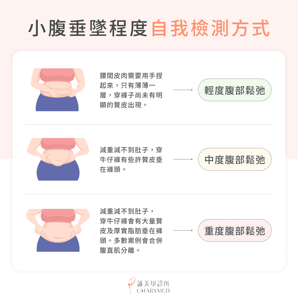 小腹垂墜程度自我檢測方式