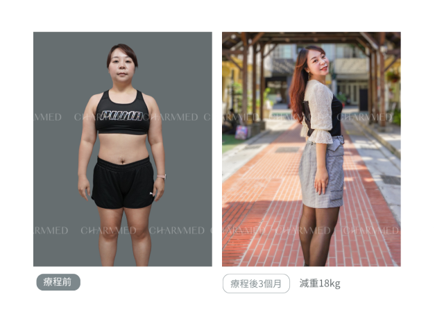 誠美學診所減重門診 胃肉毒減重成果18kg 案例